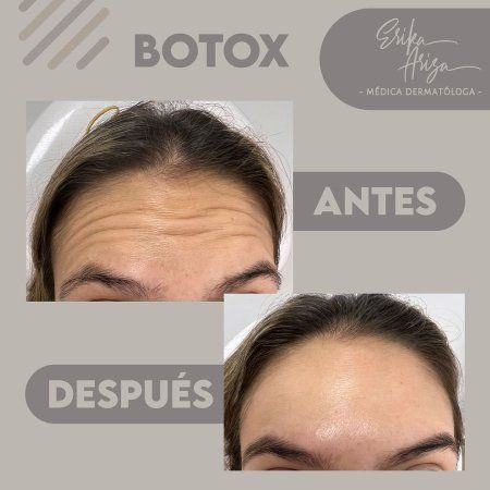 Toxina botulínica